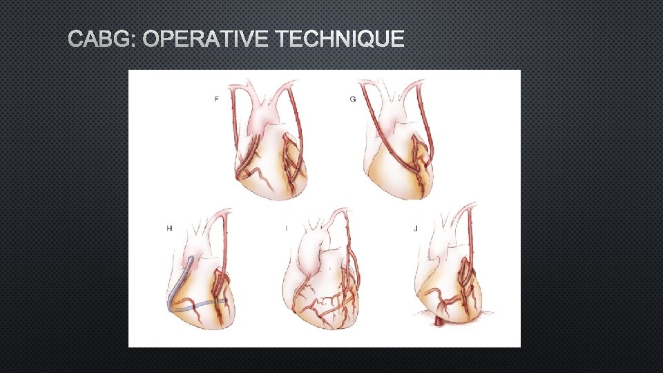 CABG: OPERATIVE TECHNIQUE 