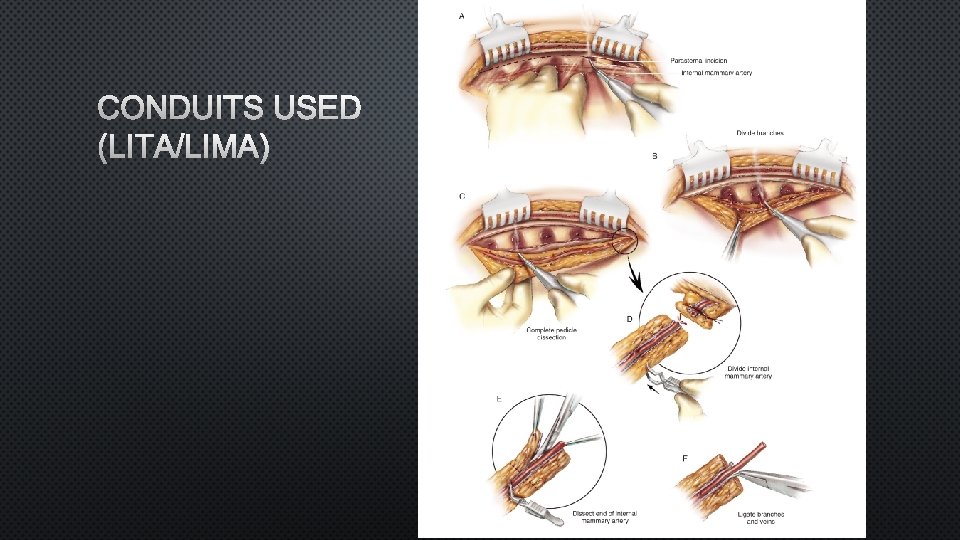 CONDUITS USED (LITA/LIMA) 