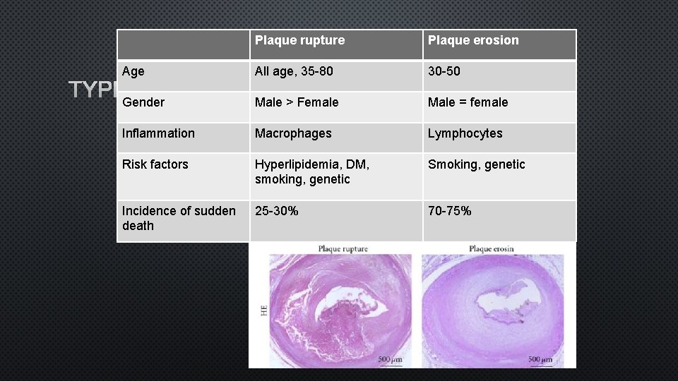 Plaque rupture Plaque erosion Age All age, 35 -80 30 -50 Inflammation Macrophages Lymphocytes