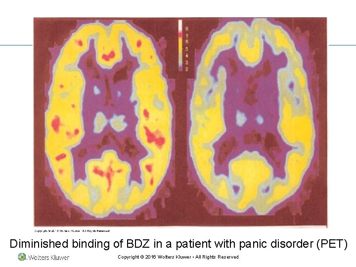 Diminished binding of BDZ in a patient with panic disorder (PET) Copyright © 2016