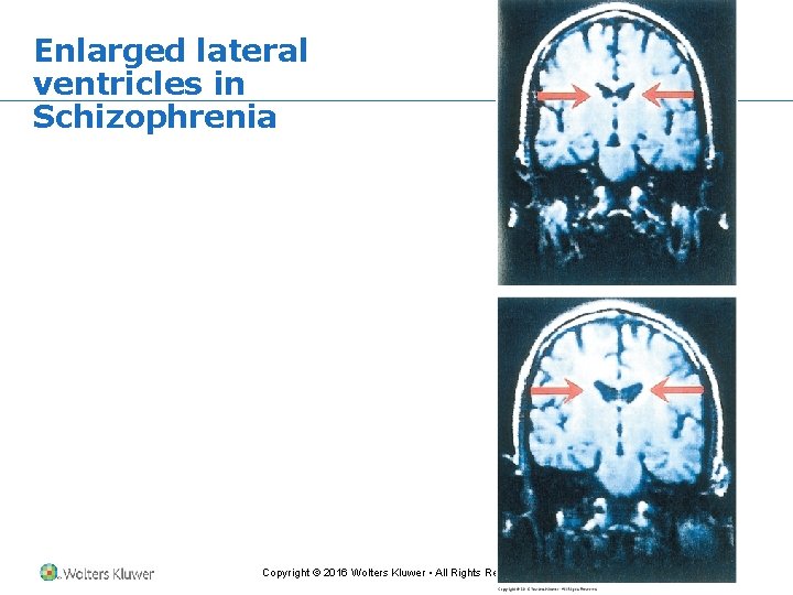 Enlarged lateral ventricles in Schizophrenia Copyright © 2016 Wolters Kluwer • All Rights Reserved