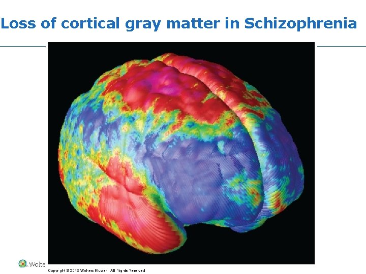 Loss of cortical gray matter in Schizophrenia Copyright © 2016 Wolters Kluwer • All