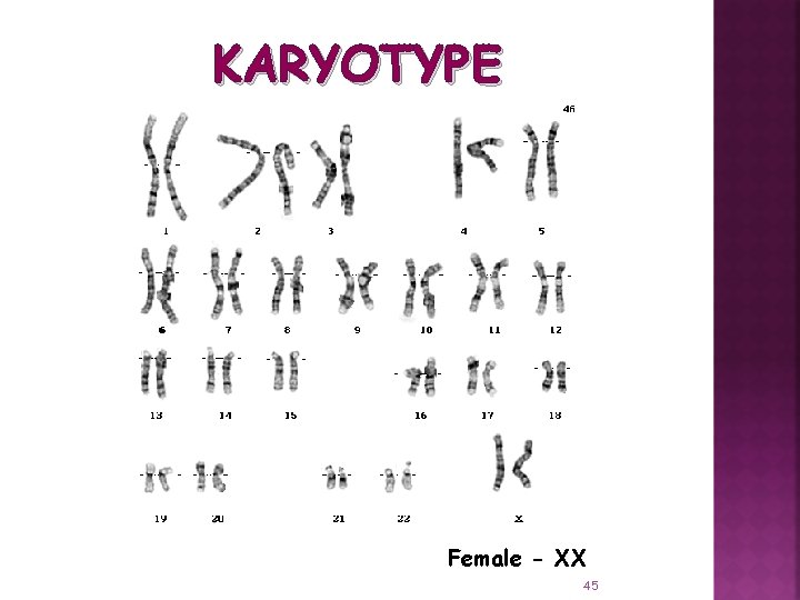 KARYOTYPE Female - XX 45 