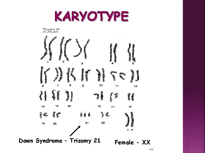 KARYOTYPE Down Syndrome – Trisomy 21 Female - XX 46 