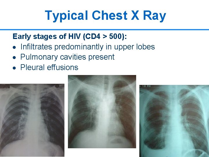 Typical Chest X Ray Early stages of HIV (CD 4 > 500): · Infiltrates
