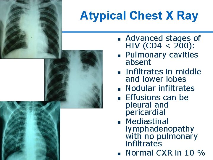 Atypical Chest X Ray n n n n Advanced stages of HIV (CD 4