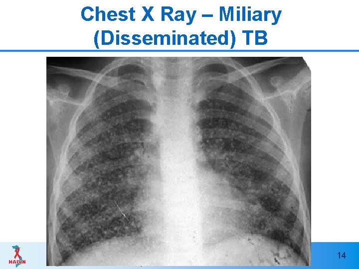 Chest X Ray – Miliary (Disseminated) TB 14 