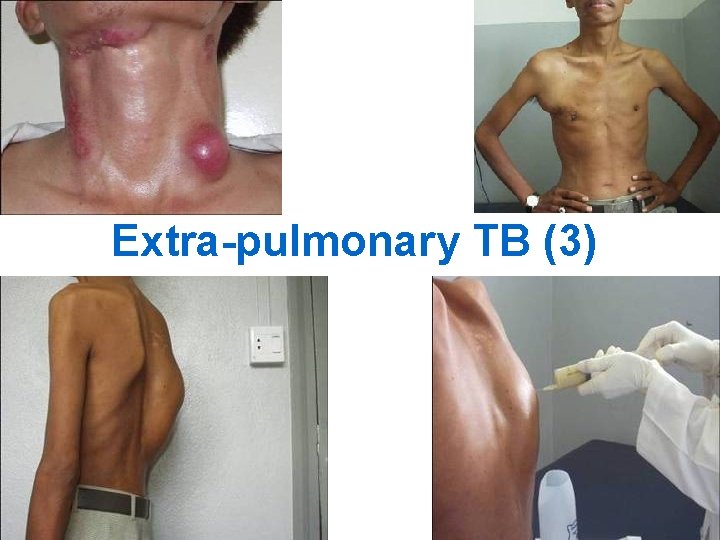 Extra-pulmonary TB (3) 17 