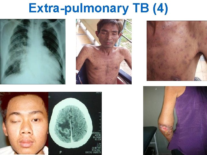 Extra-pulmonary TB (4) 18 