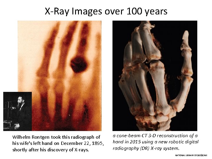 X-Ray Images over 100 years Wilhelm Rontgen took this radiograph of his wife's left