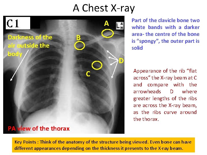 A Chest X-ray Part of the clavicle bone two white bands with a darker