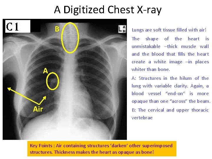 A Digitized Chest X-ray B A Air Lungs are soft tissue filled with air!