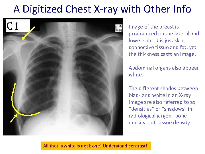A Digitized Chest X-ray with Other Info Image of the breast is pronounced on