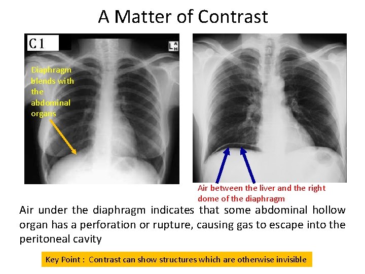 A Matter of Contrast Diaphragm blends with the abdominal organs Air between the liver
