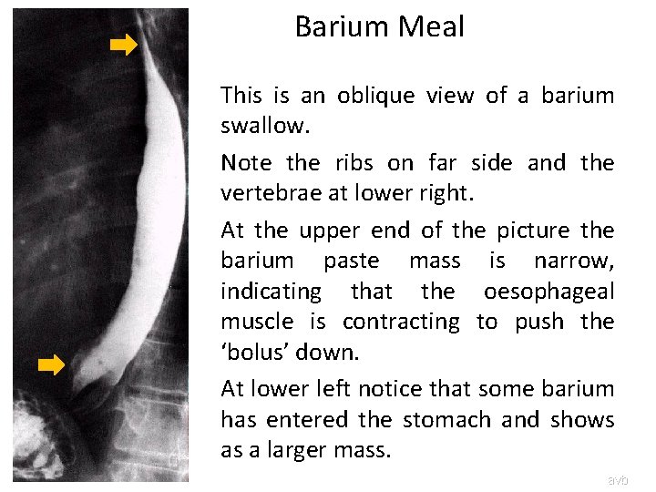 Barium Meal This is an oblique view of a barium swallow. Note the ribs