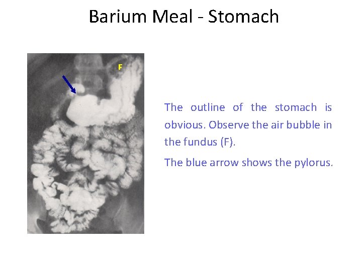 Barium Meal - Stomach F The outline of the stomach is obvious. Observe the
