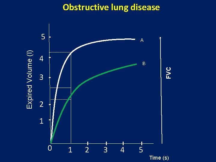 Obstructive lung disease A 4 B FVC Expired Volume (l) 5 3 2 1