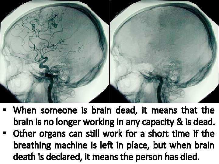 § When someone is brain dead, it means that the brain is no longer