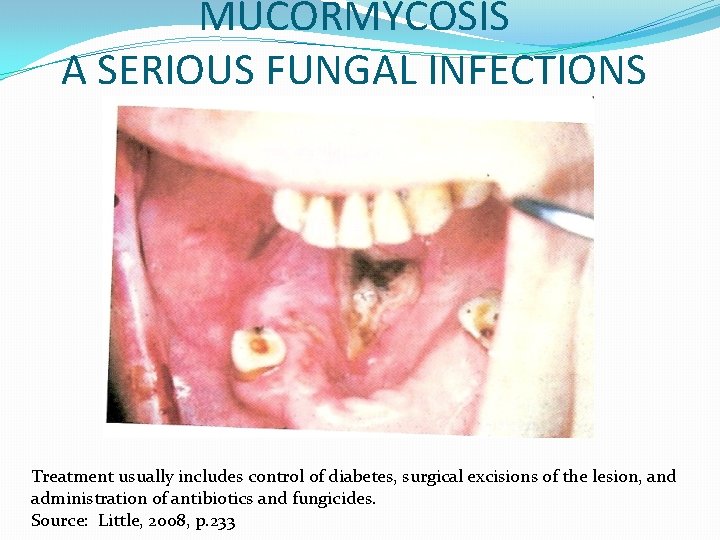 MUCORMYCOSIS A SERIOUS FUNGAL INFECTIONS Treatment usually includes control of diabetes, surgical excisions of