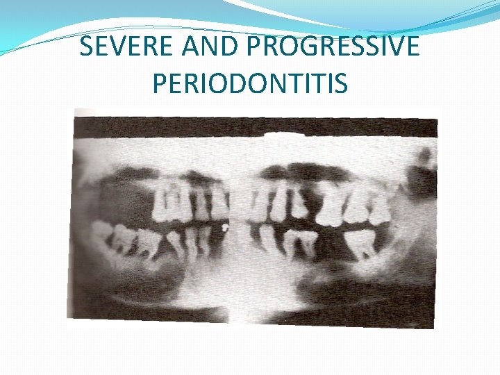 SEVERE AND PROGRESSIVE PERIODONTITIS 