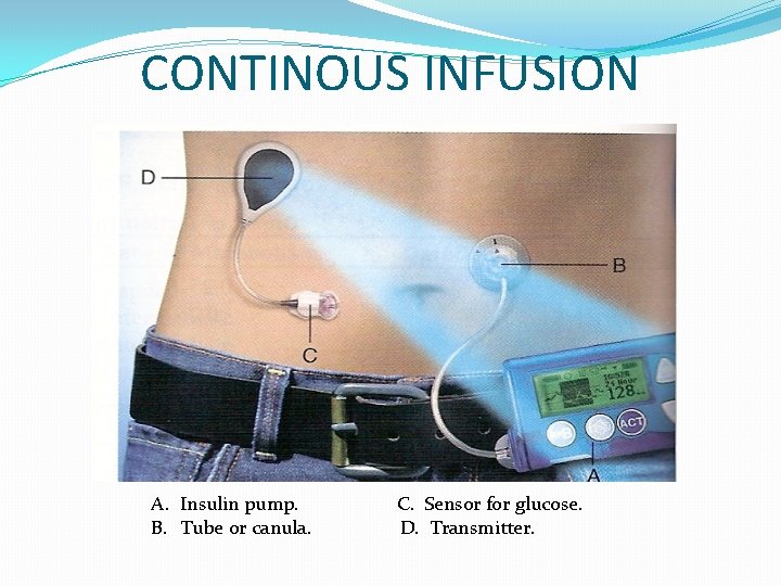 CONTINOUS INFUSION A. Insulin pump. C. Sensor for glucose. B. Tube or canula. D.