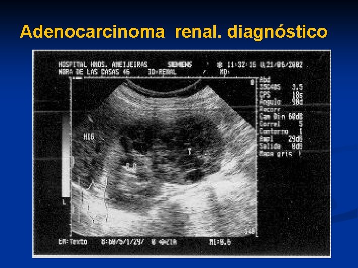 Adenocarcinoma renal. diagnóstico 