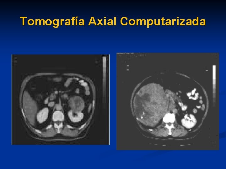 Tomografía Axial Computarizada 