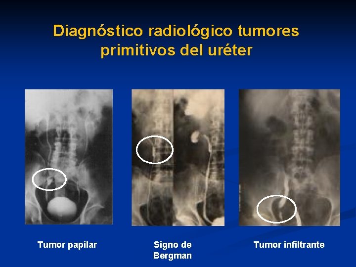 Diagnóstico radiológico tumores primitivos del uréter Tumor papilar Signo de Bergman Tumor infiltrante 