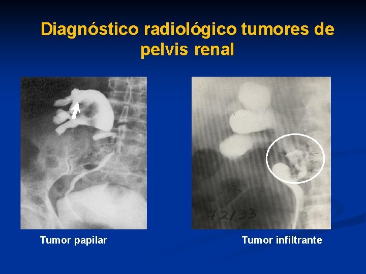 Diagnóstico radiológico tumores de pelvis renal Tumor papilar Tumor infiltrante 