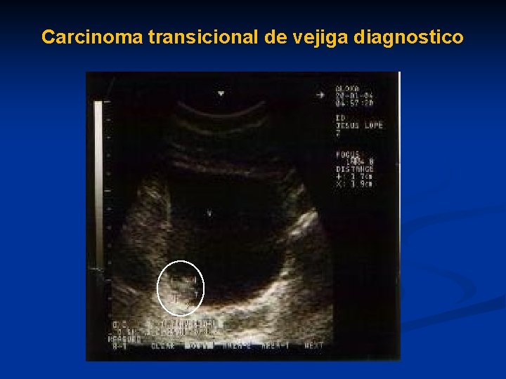 Carcinoma transicional de vejiga diagnostico 