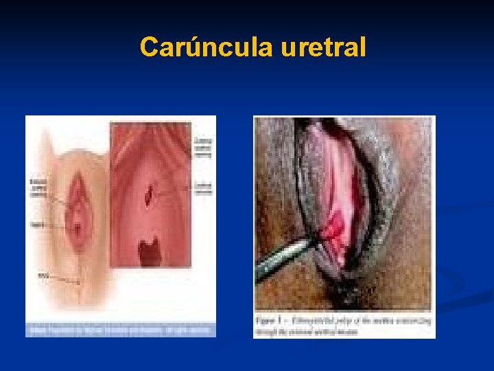 Carúncula uretral 