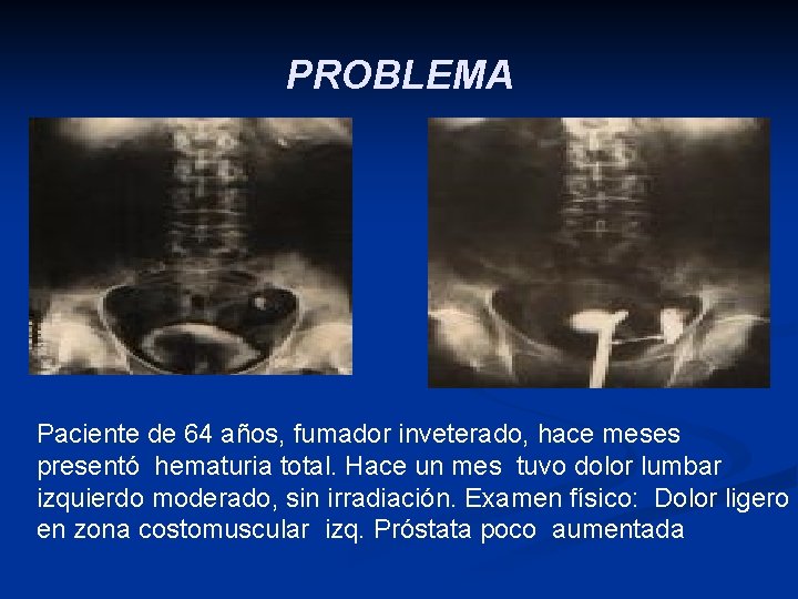 PROBLEMA Paciente de 64 años, fumador inveterado, hace meses presentó hematuria total. Hace un