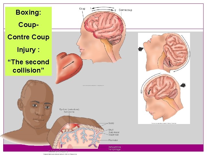 Boxing: Coup. Contre Coup Injury : “The second collision” 13 