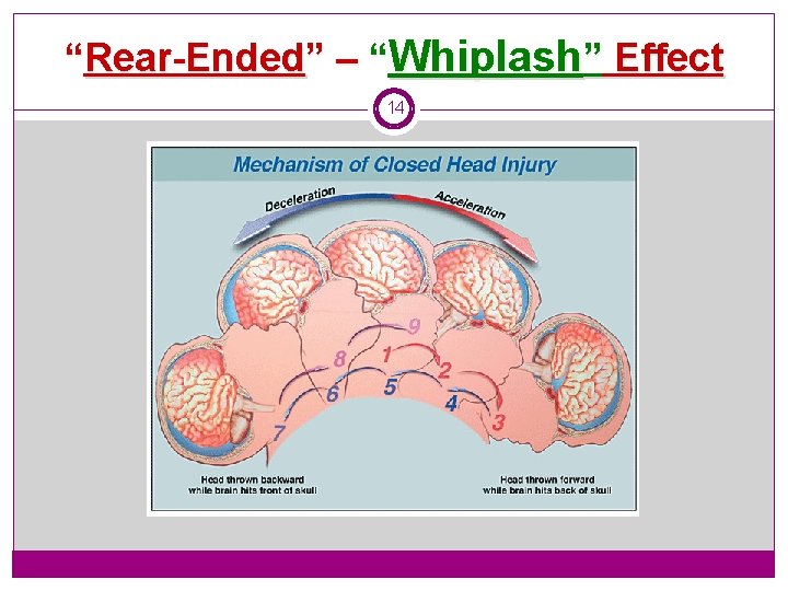 “Rear-Ended” – “Whiplash” Effect 14 