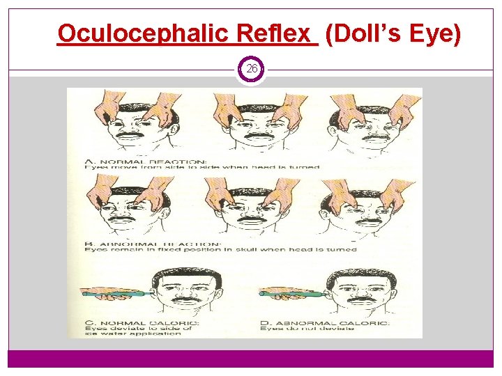 Oculocephalic Reflex (Doll’s Eye) 26 