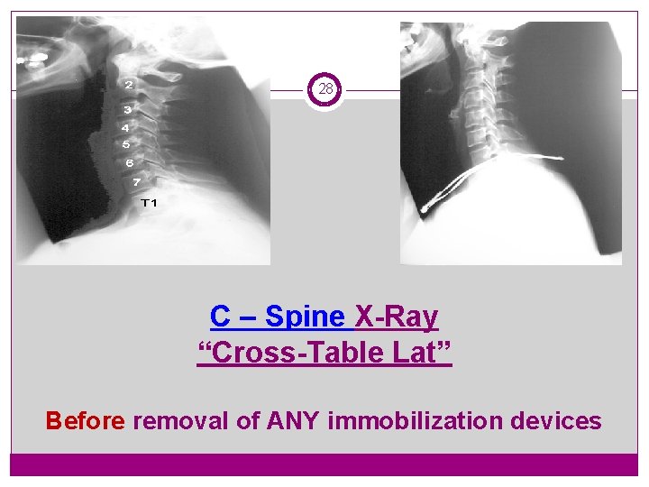 28 C – Spine X-Ray “Cross-Table Lat” Before removal of ANY immobilization devices 