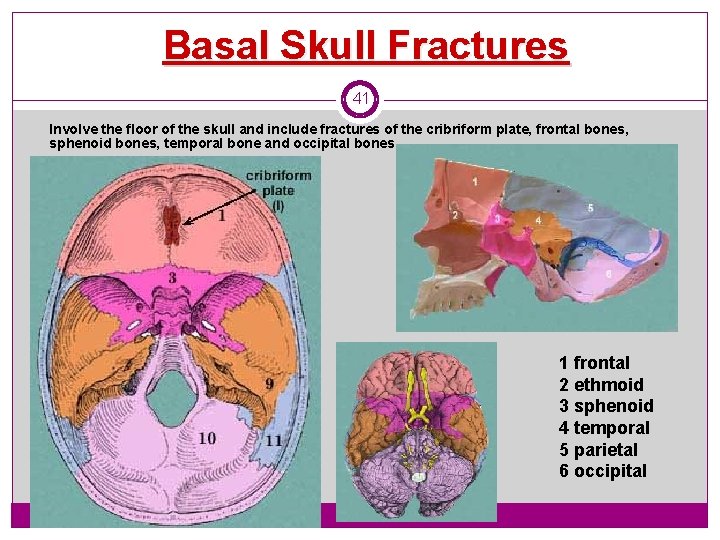 Basal Skull Fractures 41 Involve the floor of the skull and include fractures of