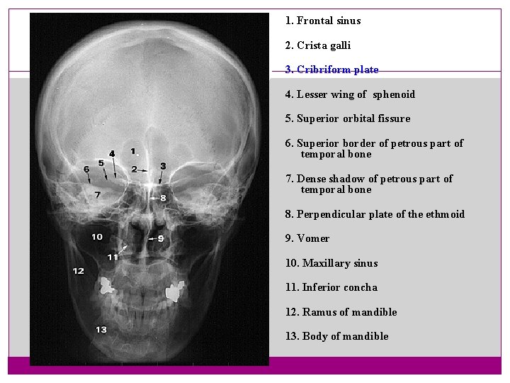 1. Frontal sinus 2. Crista galli 42 3. Cribriform plate 4. Lesser wing of