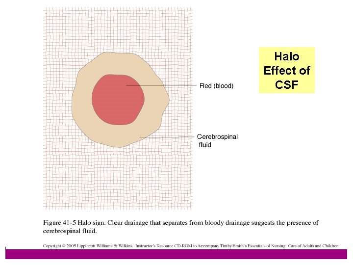 44 Halo Effect of CSF 