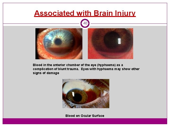 Associated with Brain Injury 48 Blood in the anterior chamber of the eye (hyphaema)