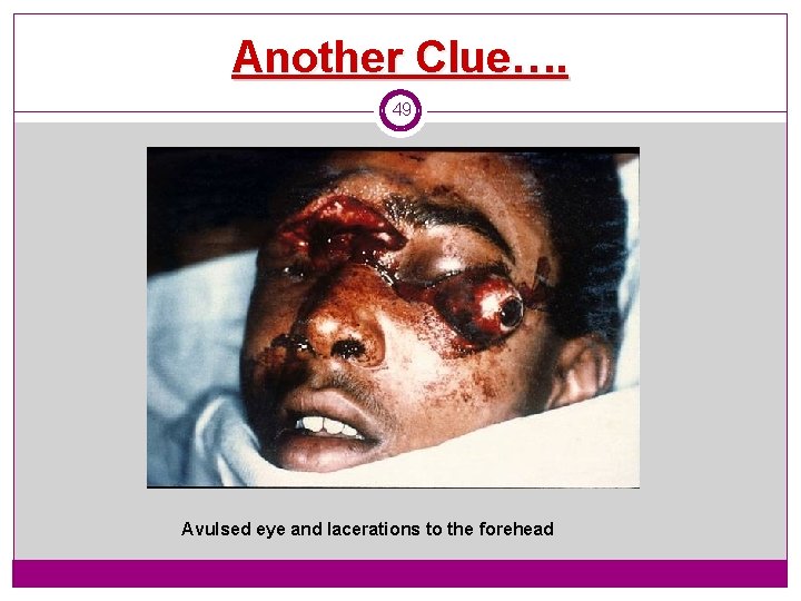 Another Clue…. 49 Avulsed eye and lacerations to the forehead 