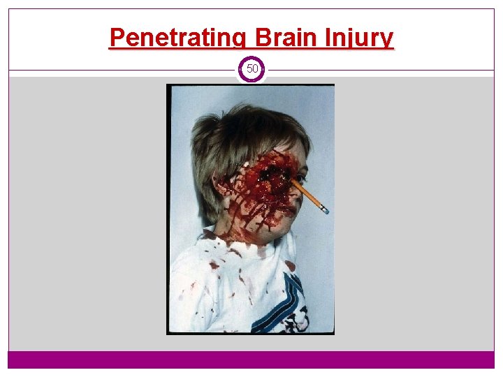 Penetrating Brain Injury 50 