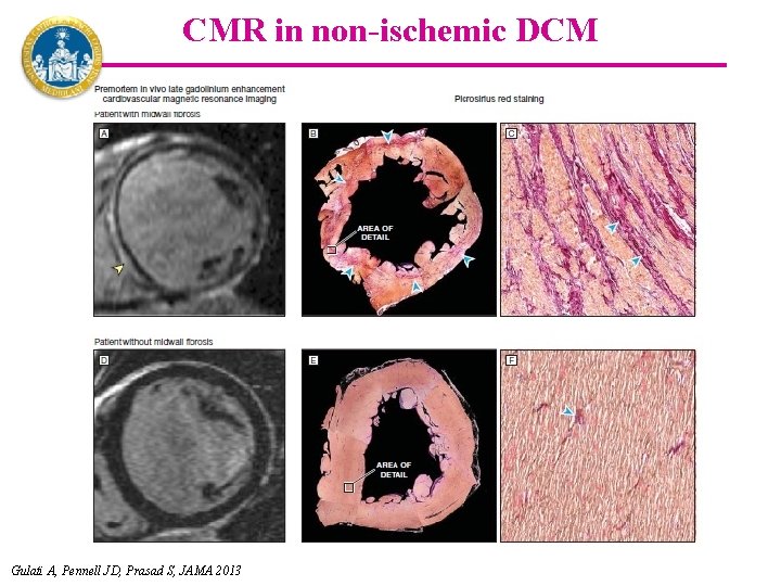 CMR in non-ischemic DCM Gulati A, Pennell JD, Prasad S, JAMA 2013 