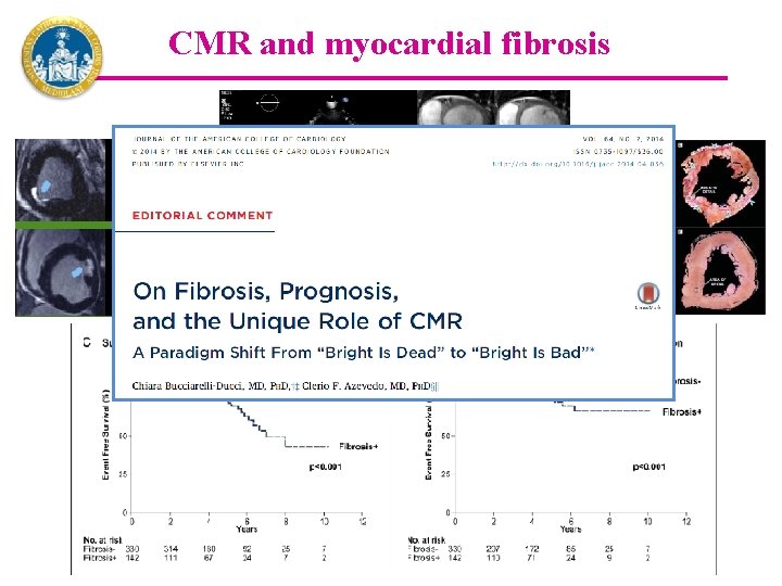 CMR and myocardial fibrosis 