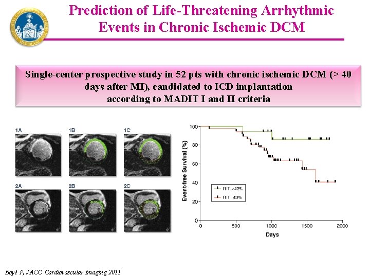 Prediction of Life-Threatening Arrhythmic Events in Chronic Ischemic DCM Single-center prospective study in 52