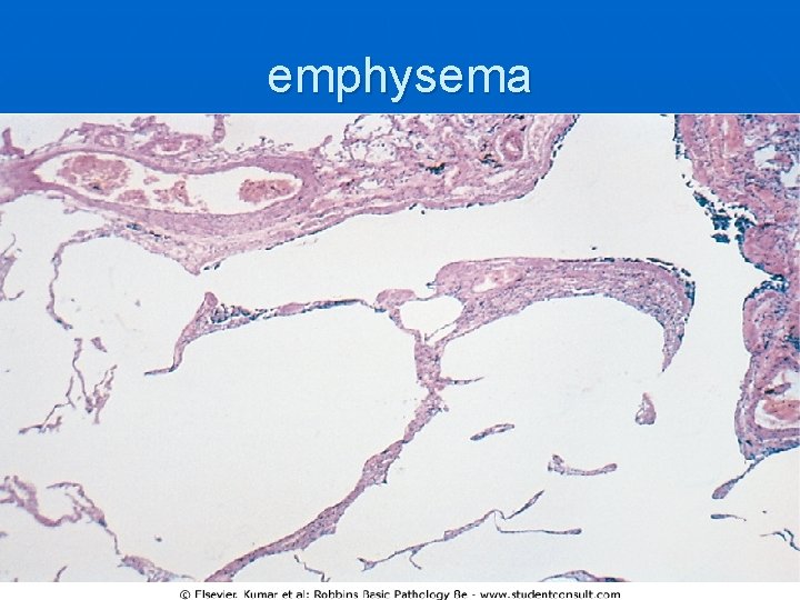 emphysema 
