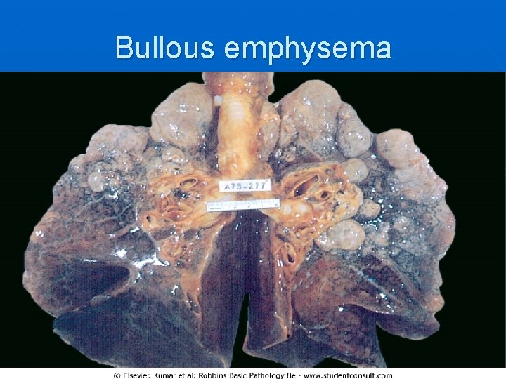 Bullous emphysema 