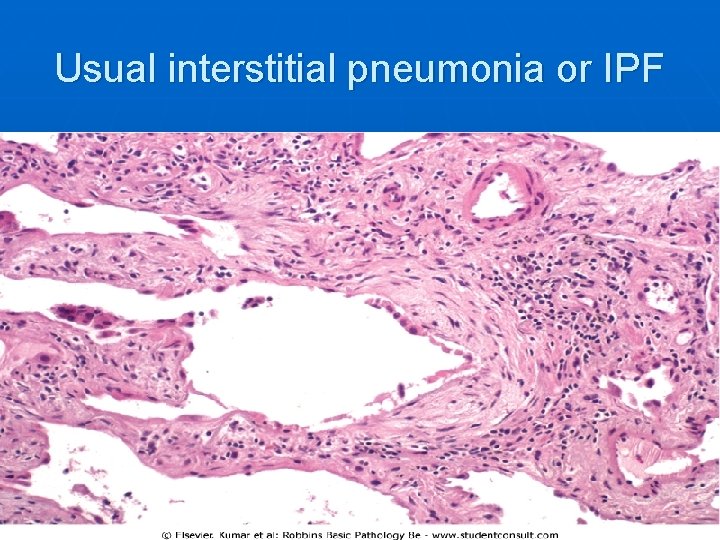 Usual interstitial pneumonia or IPF 