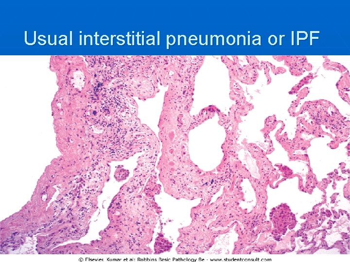 Usual interstitial pneumonia or IPF 