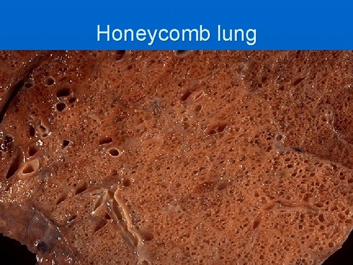 Honeycomb lung 